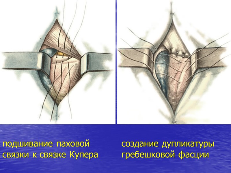 подшивание паховой  связки к связке Купера создание дупликатуры гребешковой фасции
